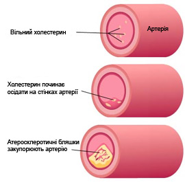 Формування атеросклеротичних бляшок в судинах підвищує ризик інфаркту або ішемічного інсульту, а також інших серцево-судинних ускладнень